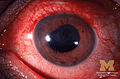 目の痛み、目の奥の痛みを伴うブドウ膜炎、虹彩炎
