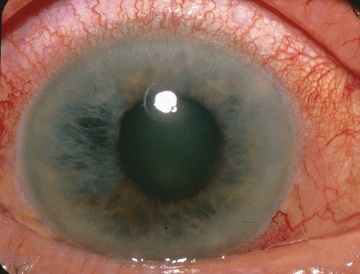 目の痛み、目の奥の痛みを伴う閉塞隅角緑内障(急性)