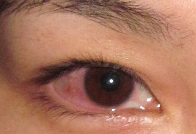目の痛み、目の奥の痛みを伴う結膜炎（アレルギー性結膜炎）