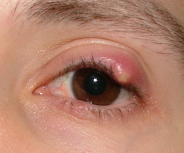 目の痛み、目の奥の痛みを伴う霰粒腫（さんりゅうしゅ）