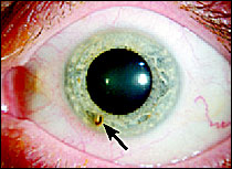 目の痛み、目の奥の痛みを伴う角膜