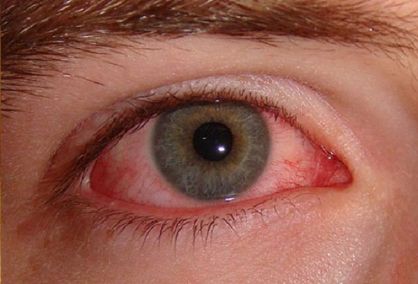 目の痛み、目の奥の痛みを伴う角膜感染症