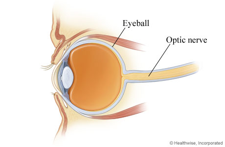 目の痛み、目の奥の痛みを伴う視神経炎